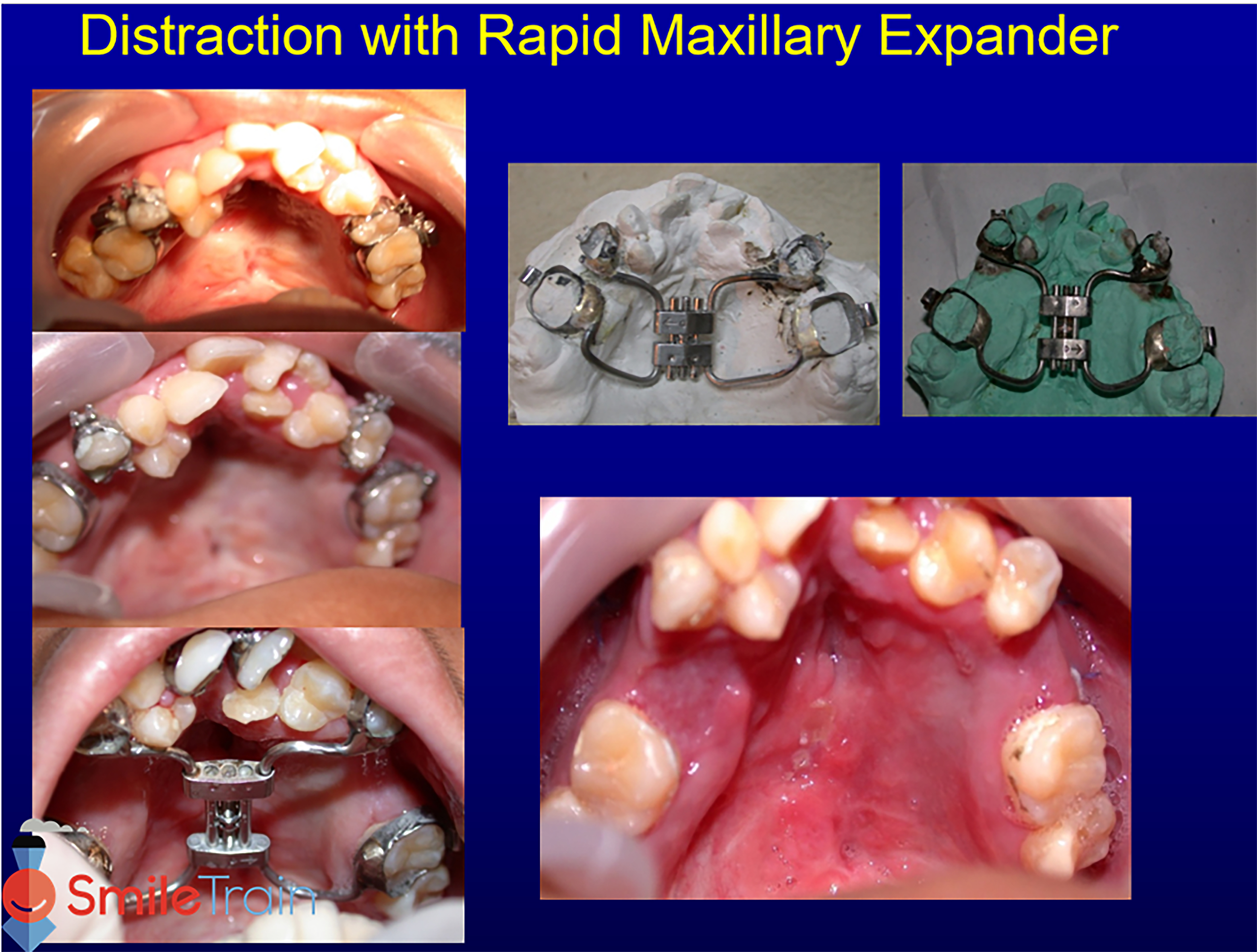 Osteotomy & Osteodistraction