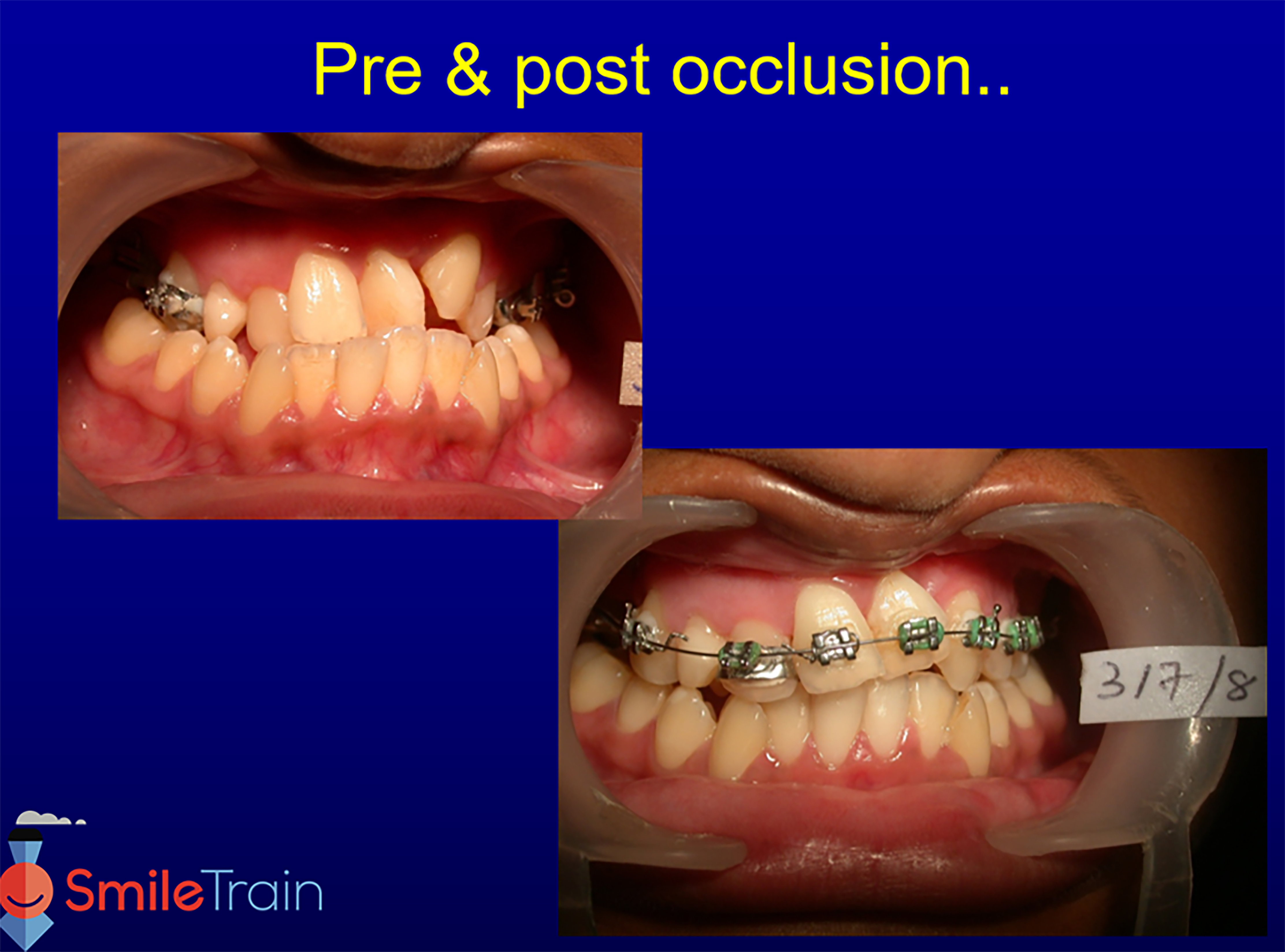 Osteotomy & Osteodistraction