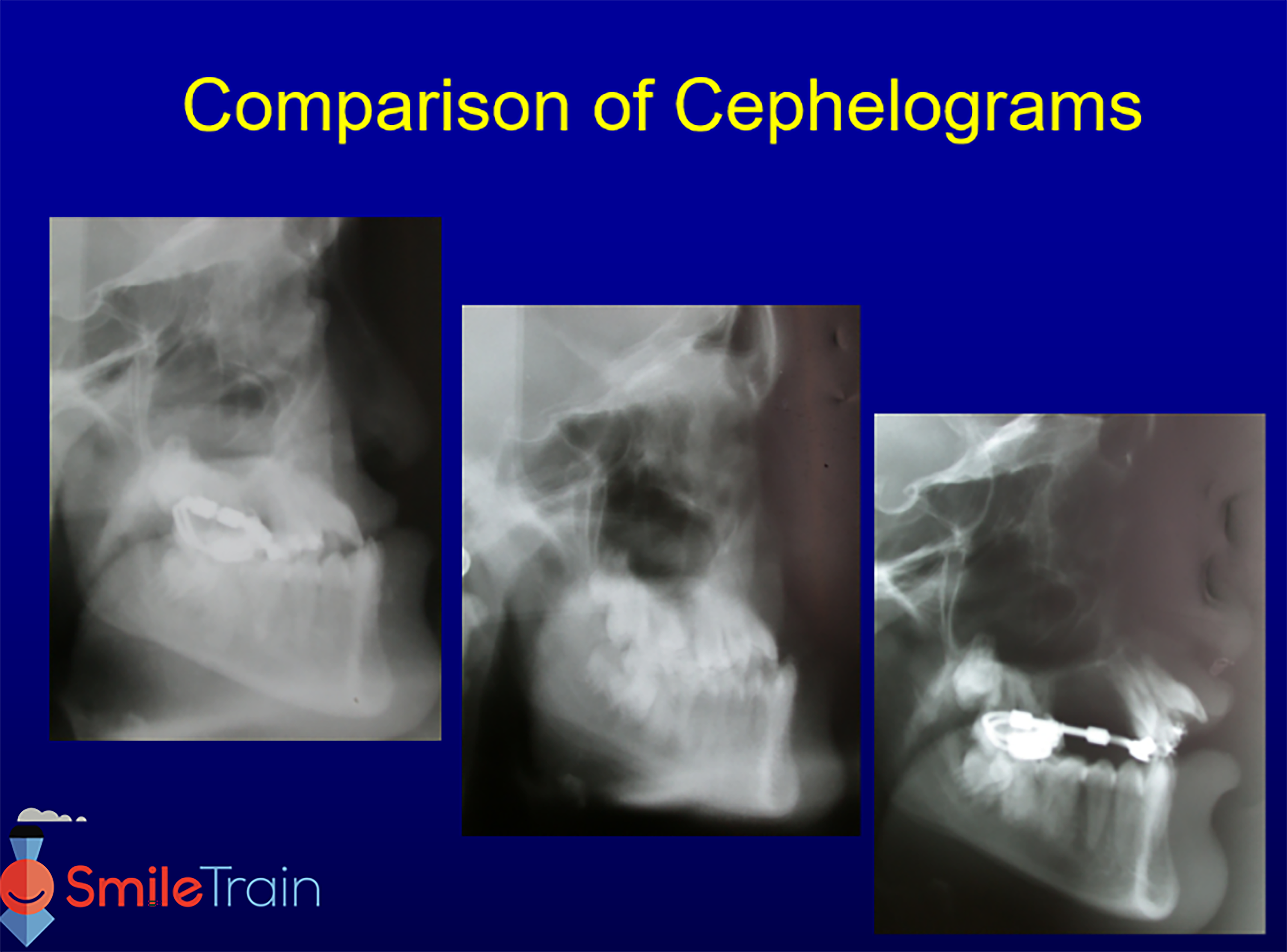 Osteotomy & Osteodistraction