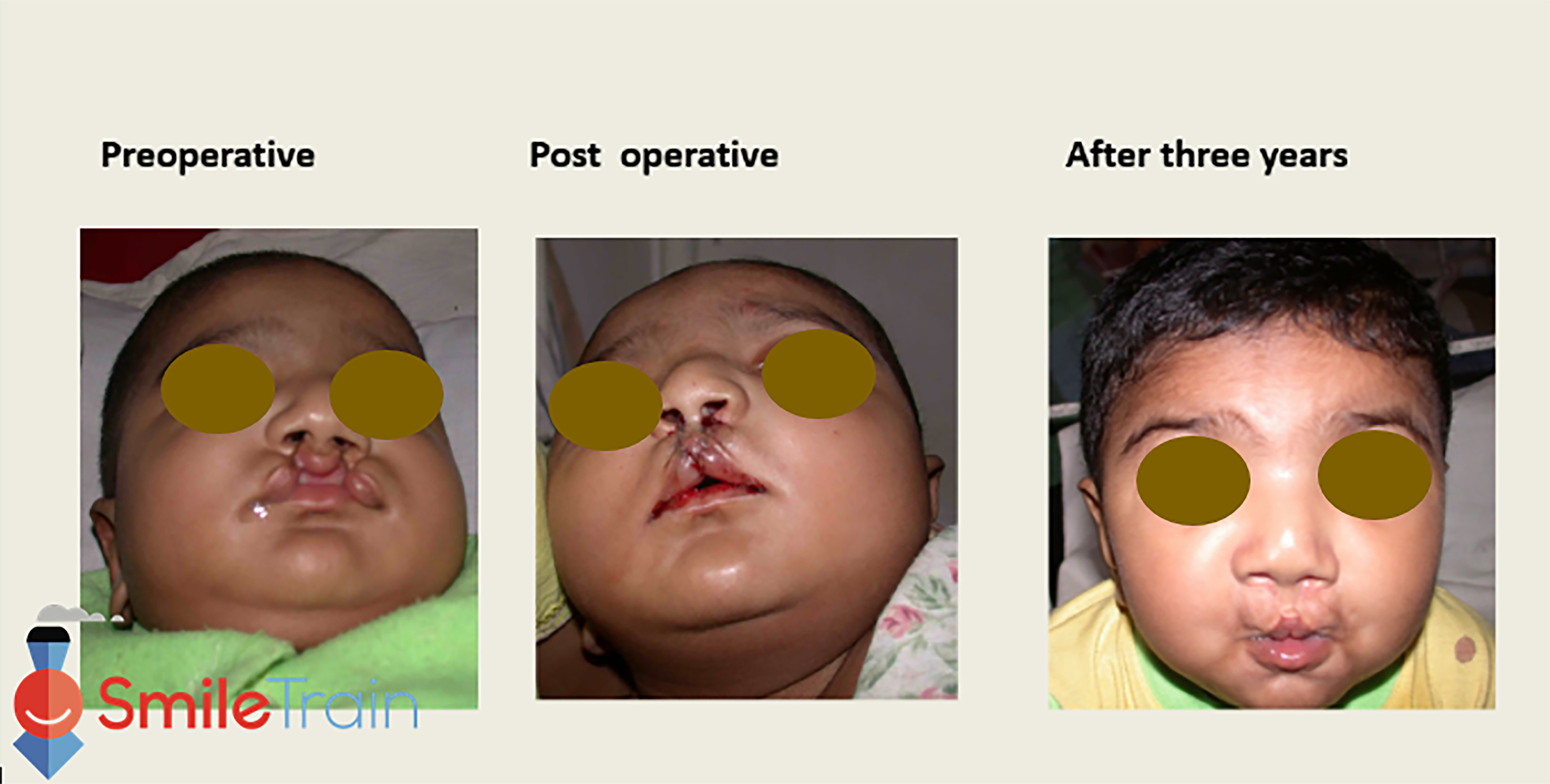 Cleft Lip - Bilateral Cleft Lip