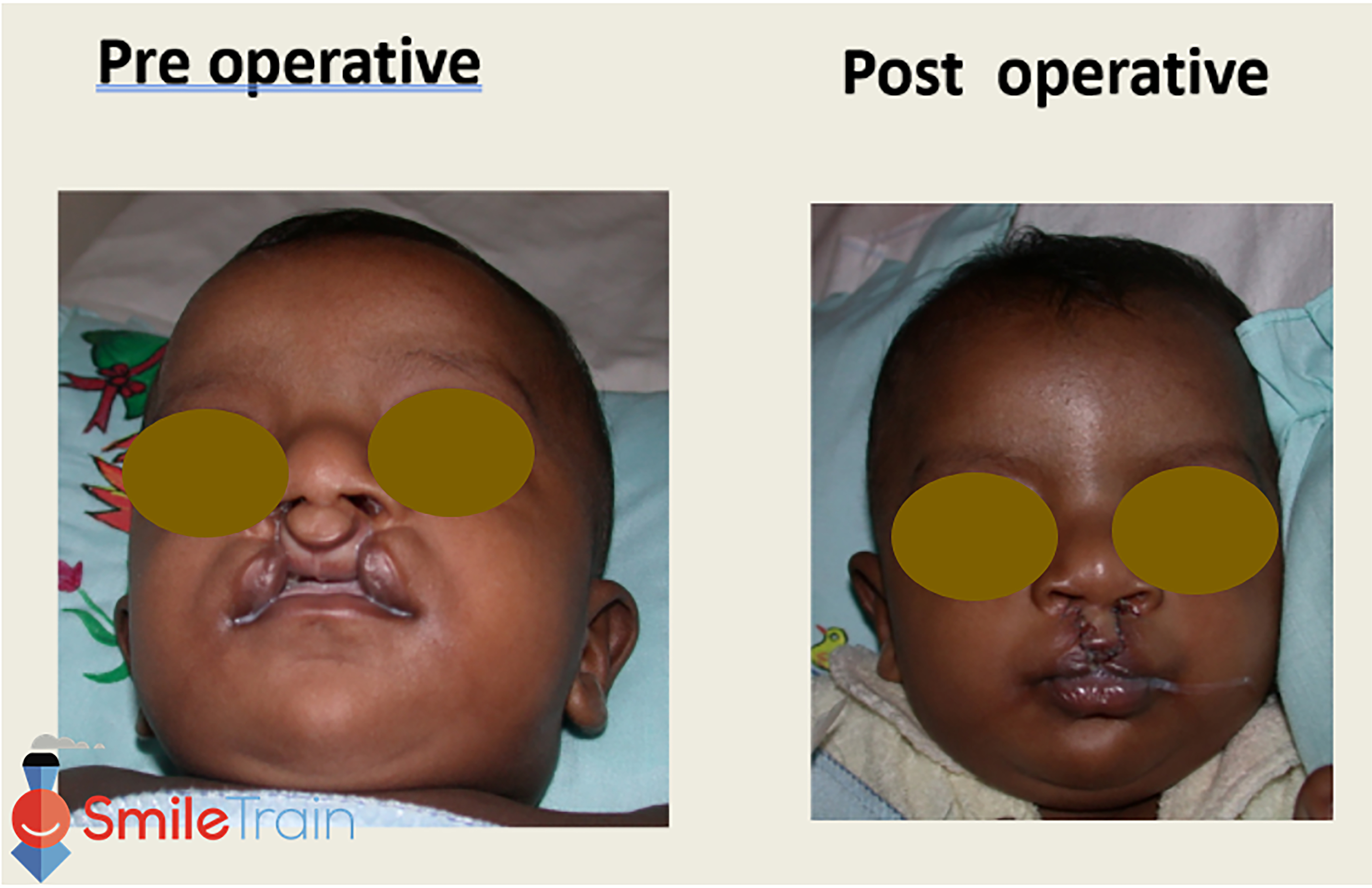 Cleft Lip - Bilateral Cleft Lip