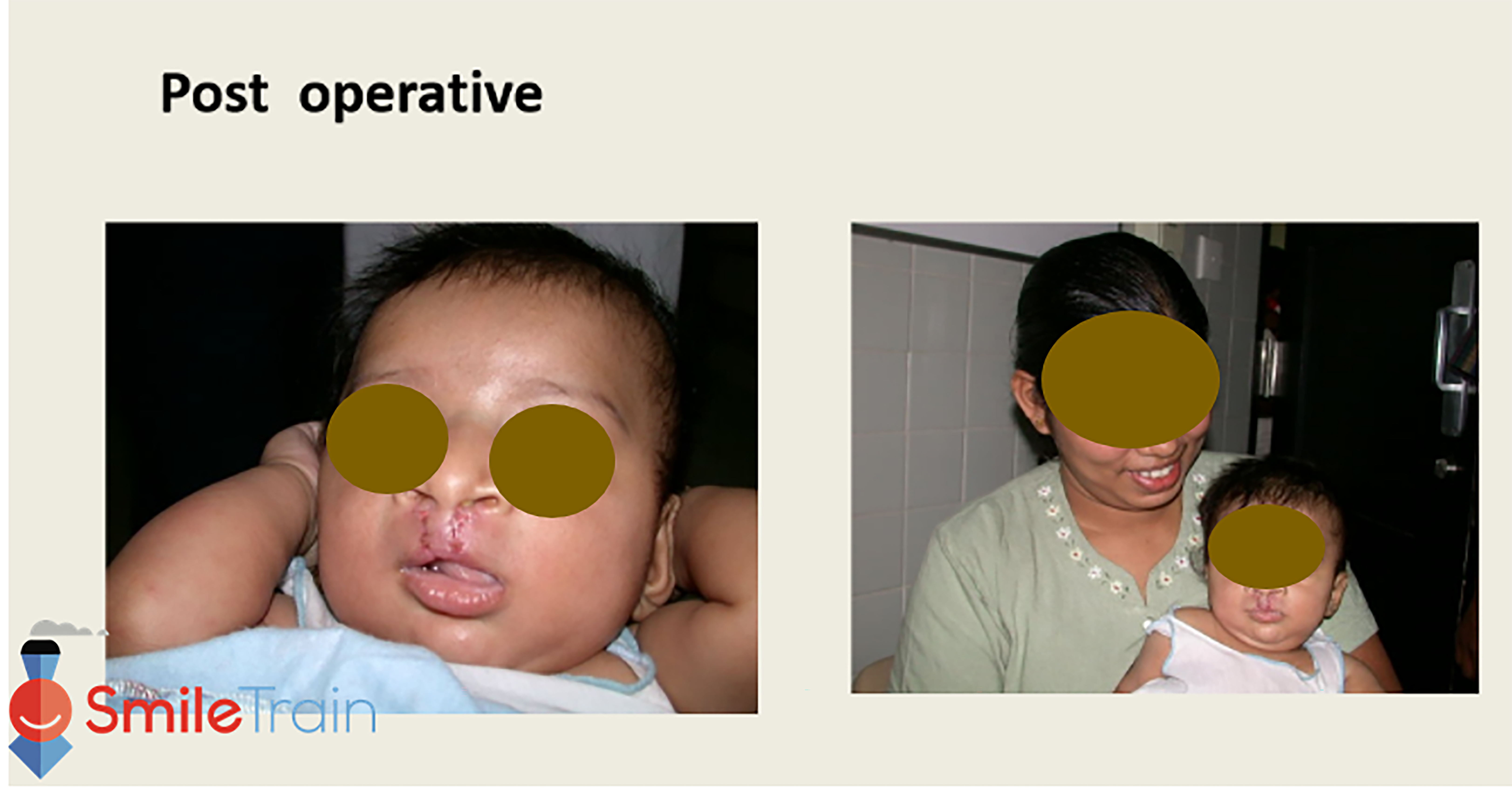Cleft Lip - Bilateral Cleft Lip