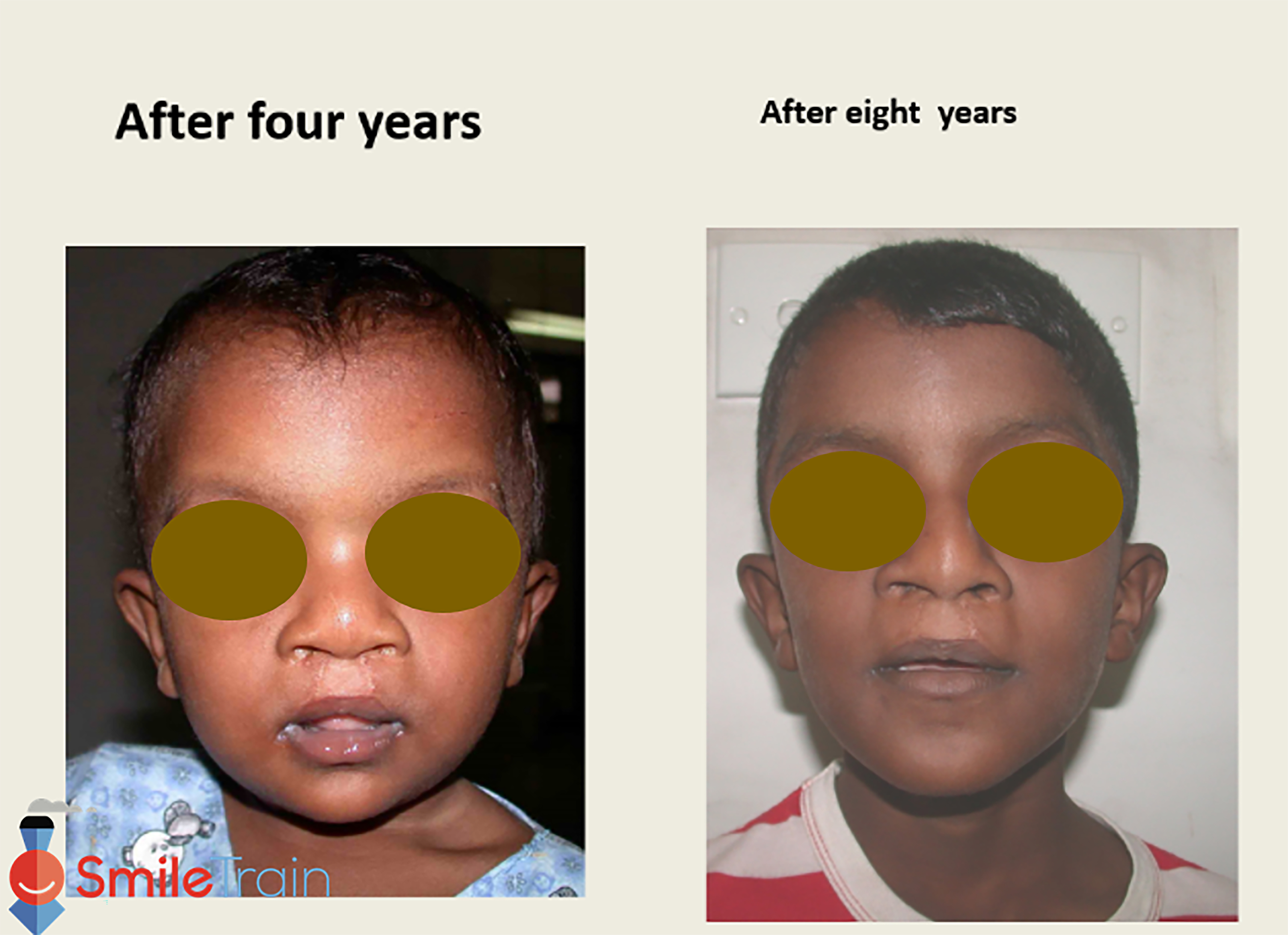 Cleft Lip - Bilateral Cleft Lip
