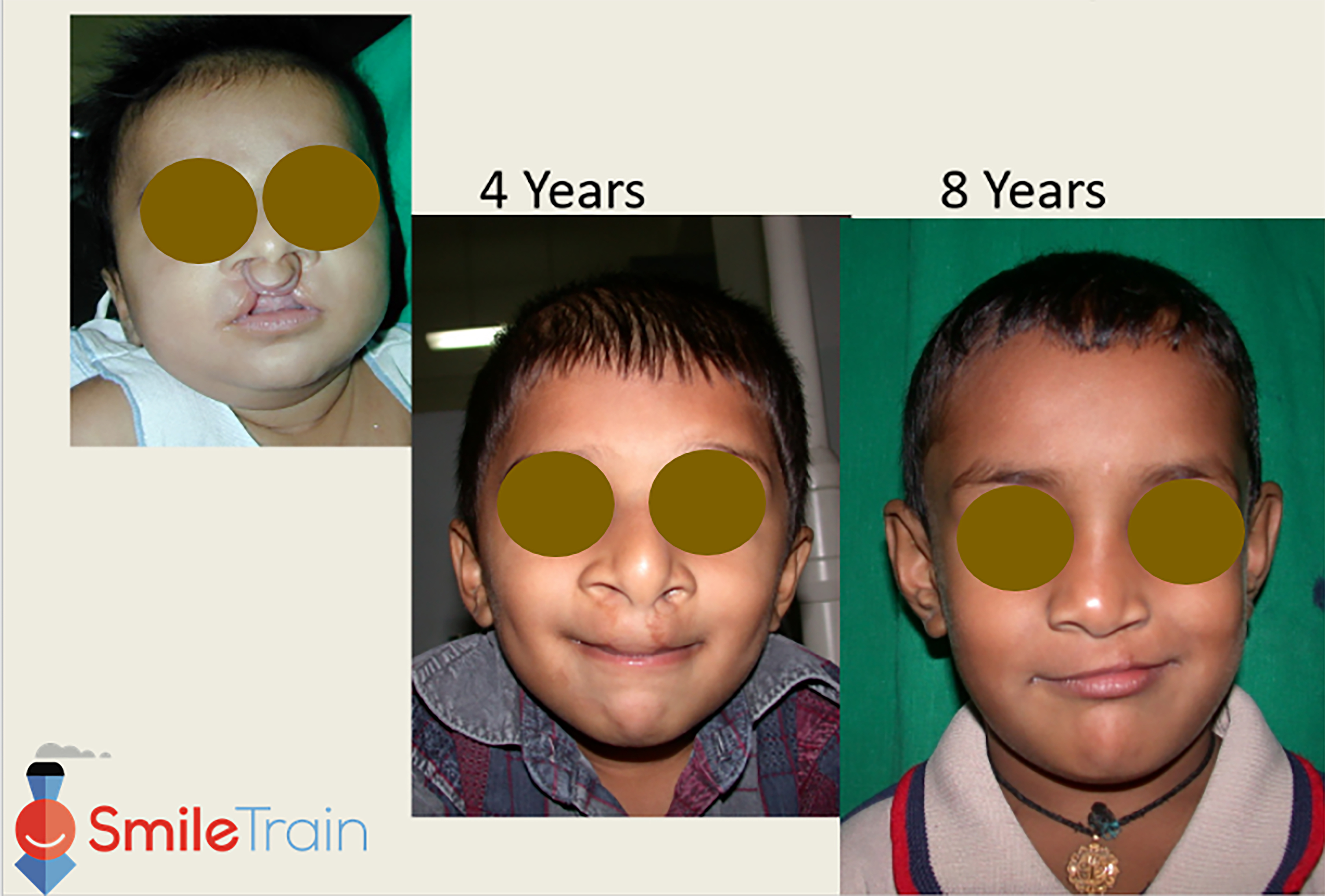 Cleft Lip - Bilateral Cleft Lip