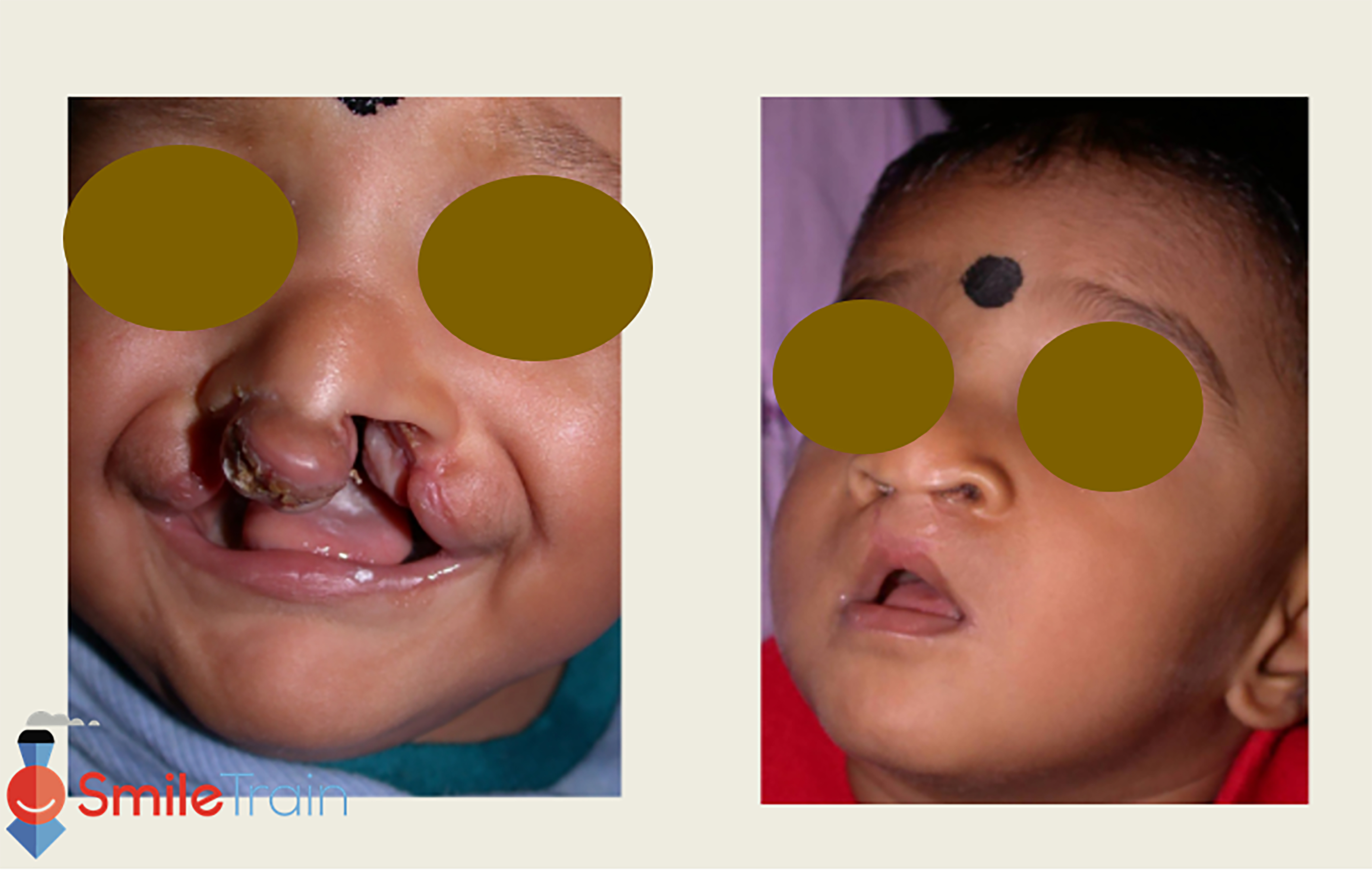 Cleft Lip - Bilateral Cleft Lip