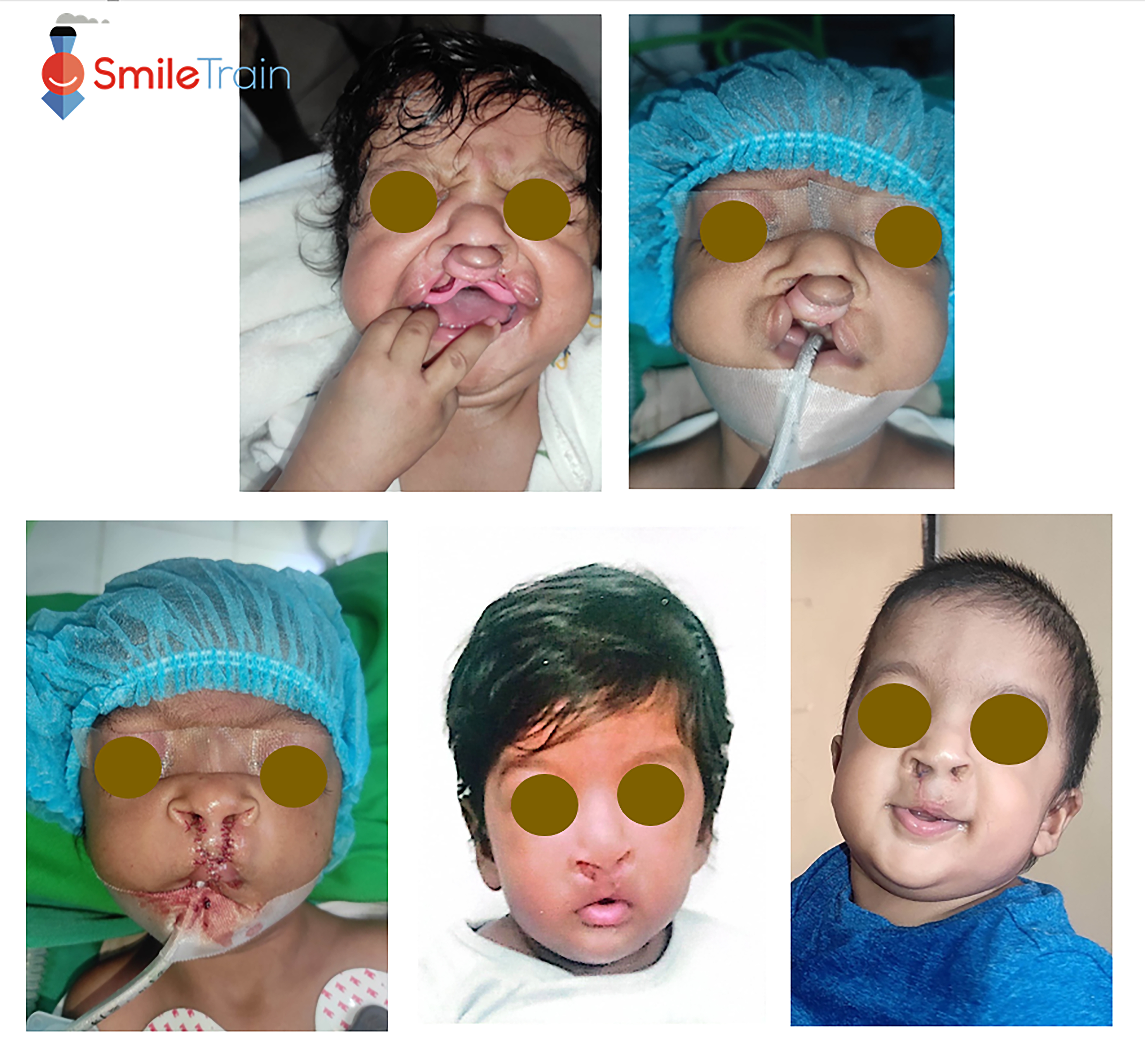 Cleft Lip - Bilateral Cleft Lip