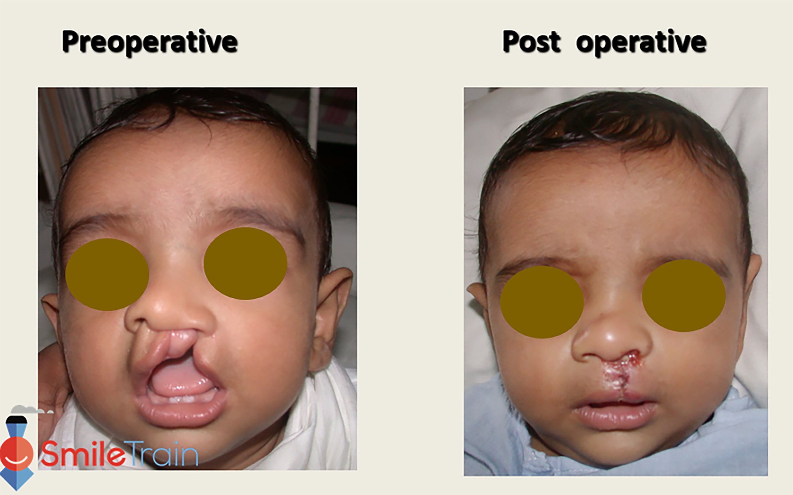 Cleft Lip - Unilateral Cleft Lip