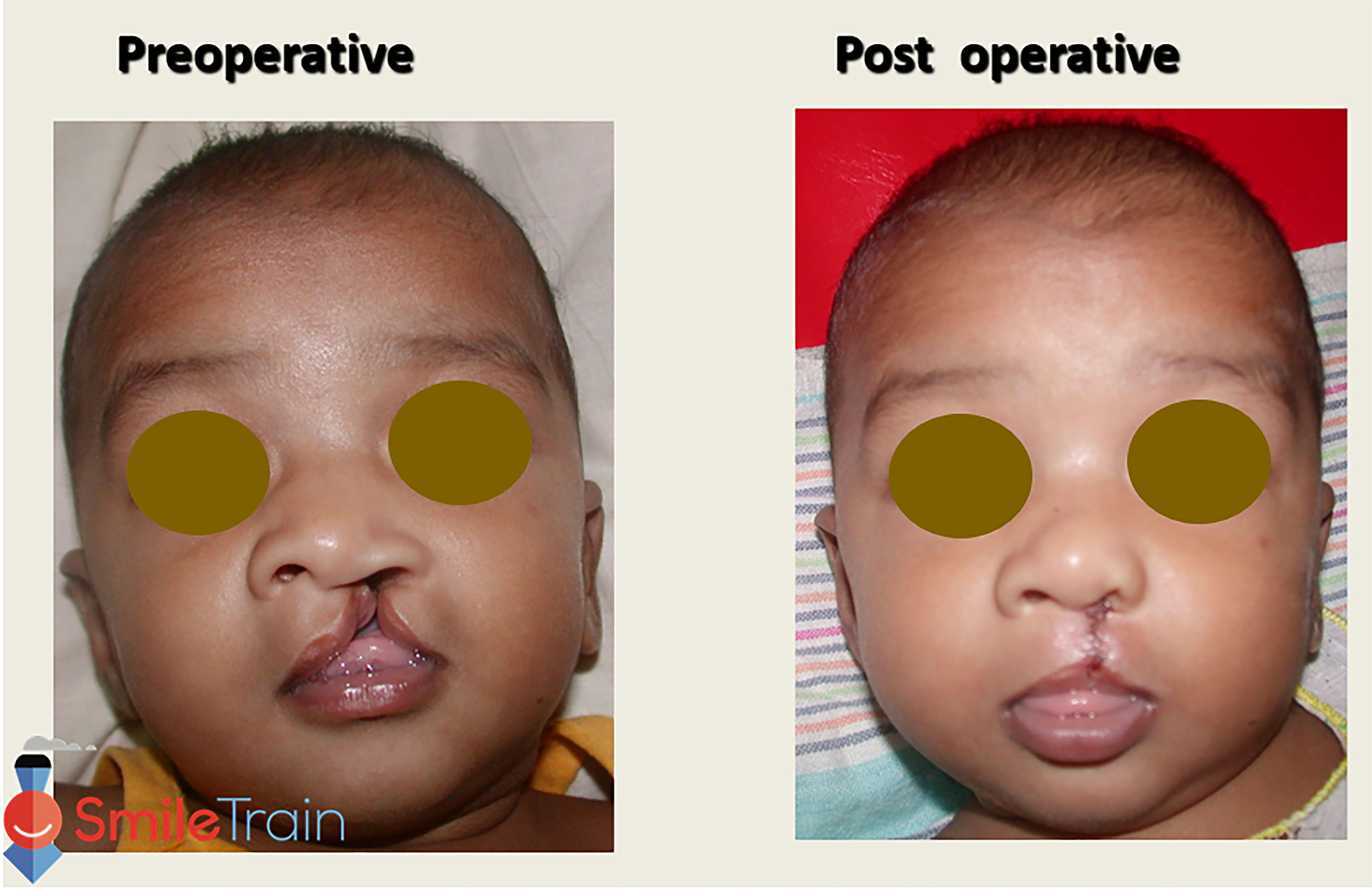 Cleft Lip - Unilateral Cleft Lip