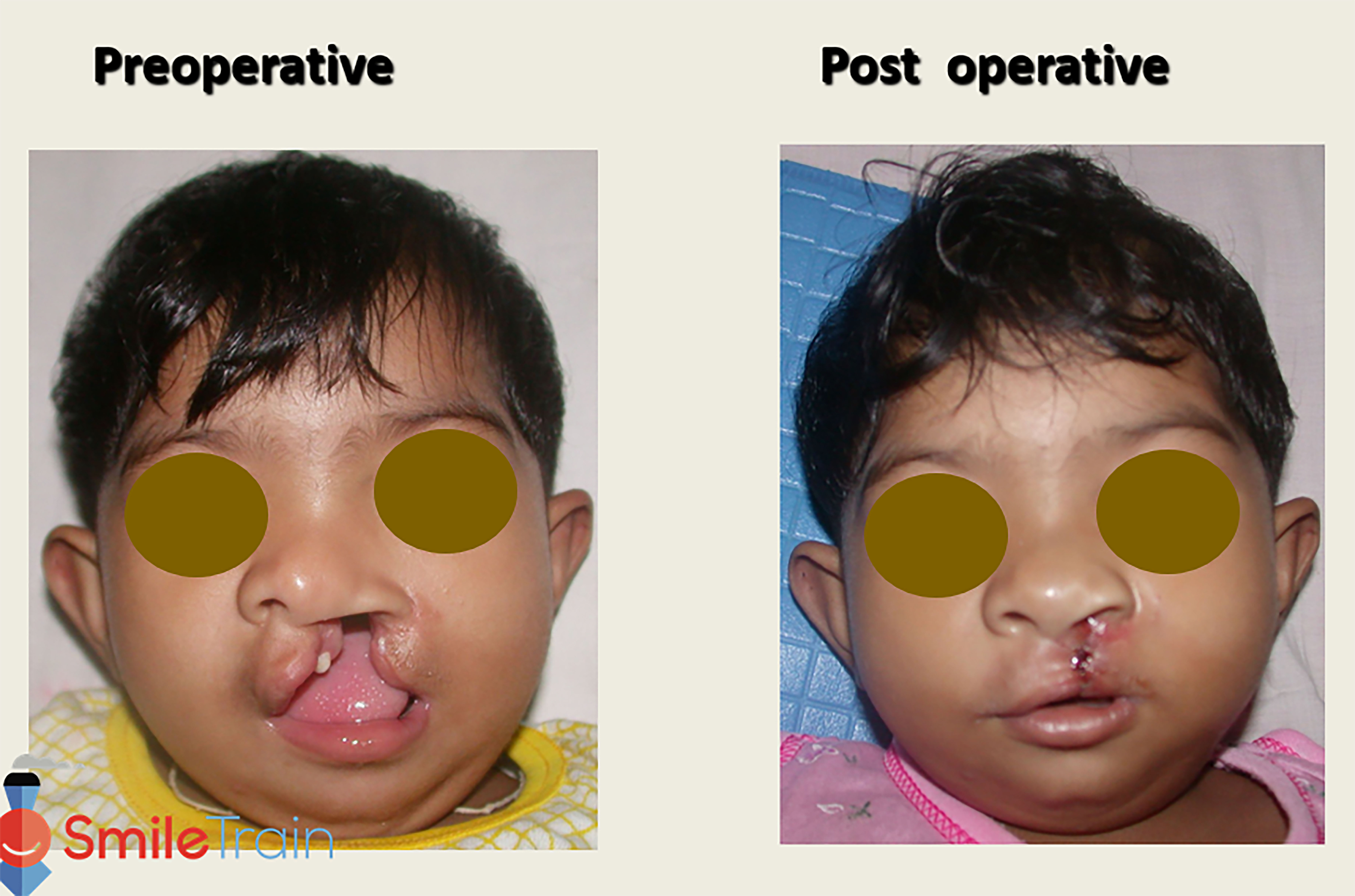 Cleft Lip - Unilateral Cleft Lip