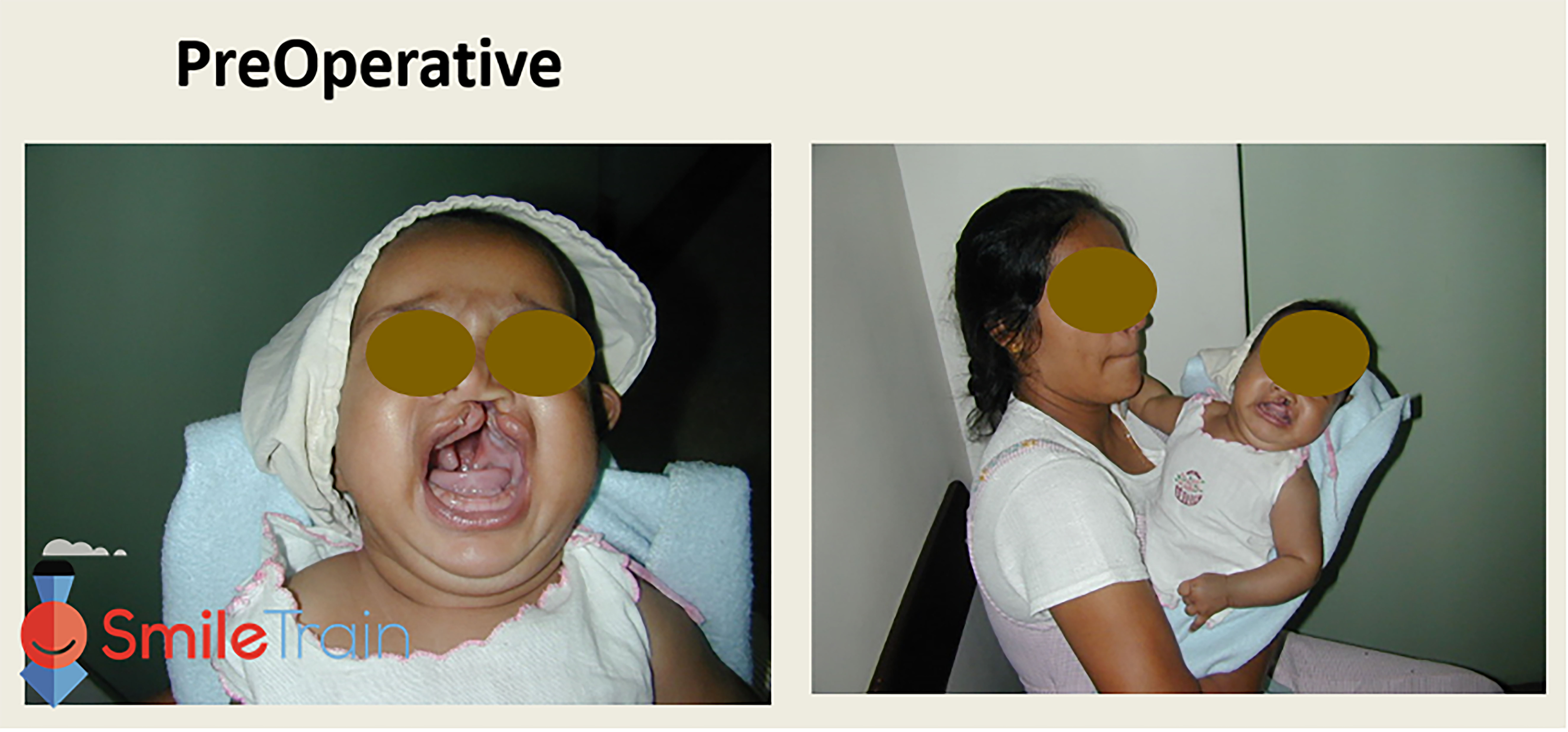 Cleft Lip - Unilateral Cleft Lip