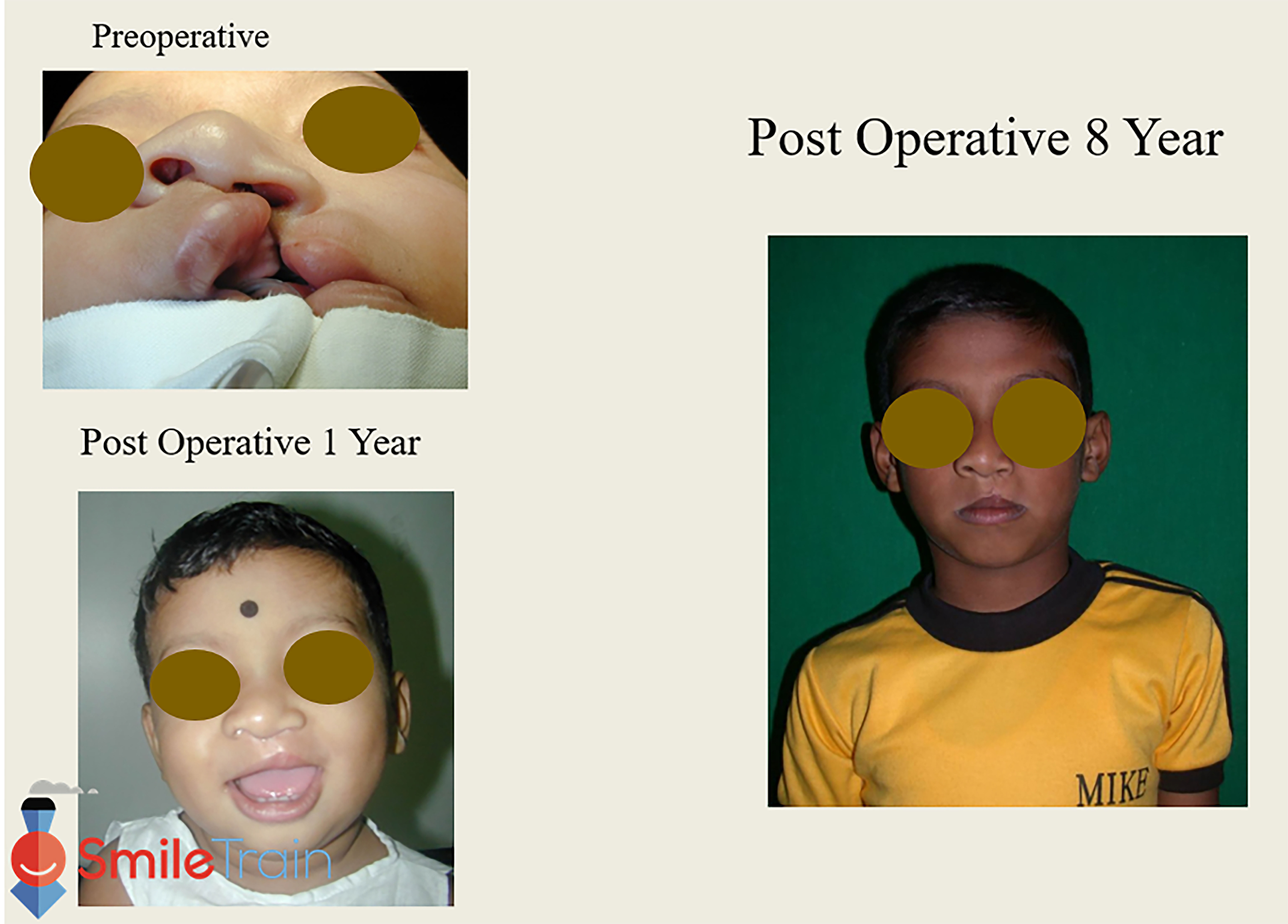 Cleft Lip - Unilateral Cleft Lip