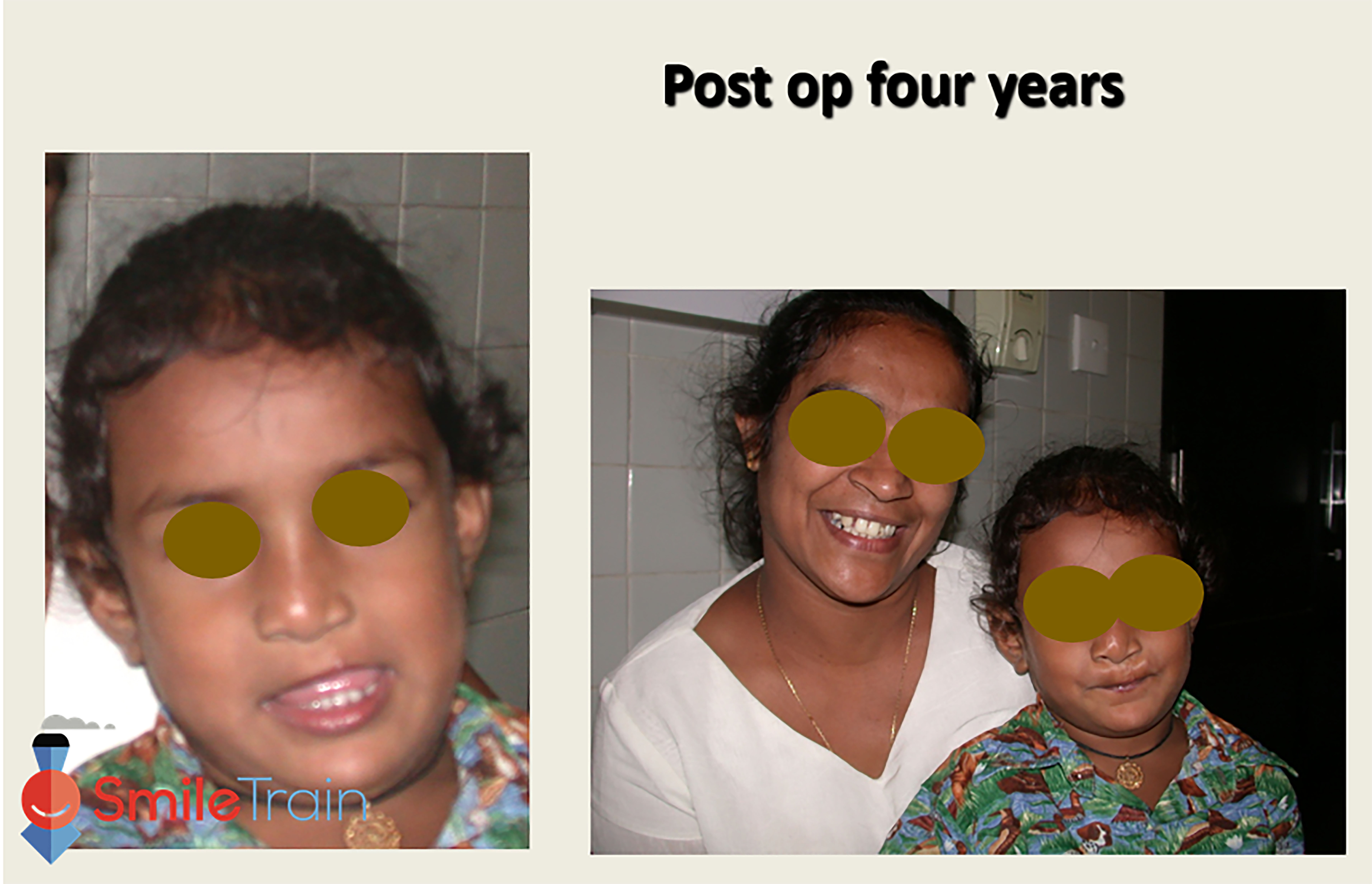 Cleft Lip - Unilateral Cleft Lip