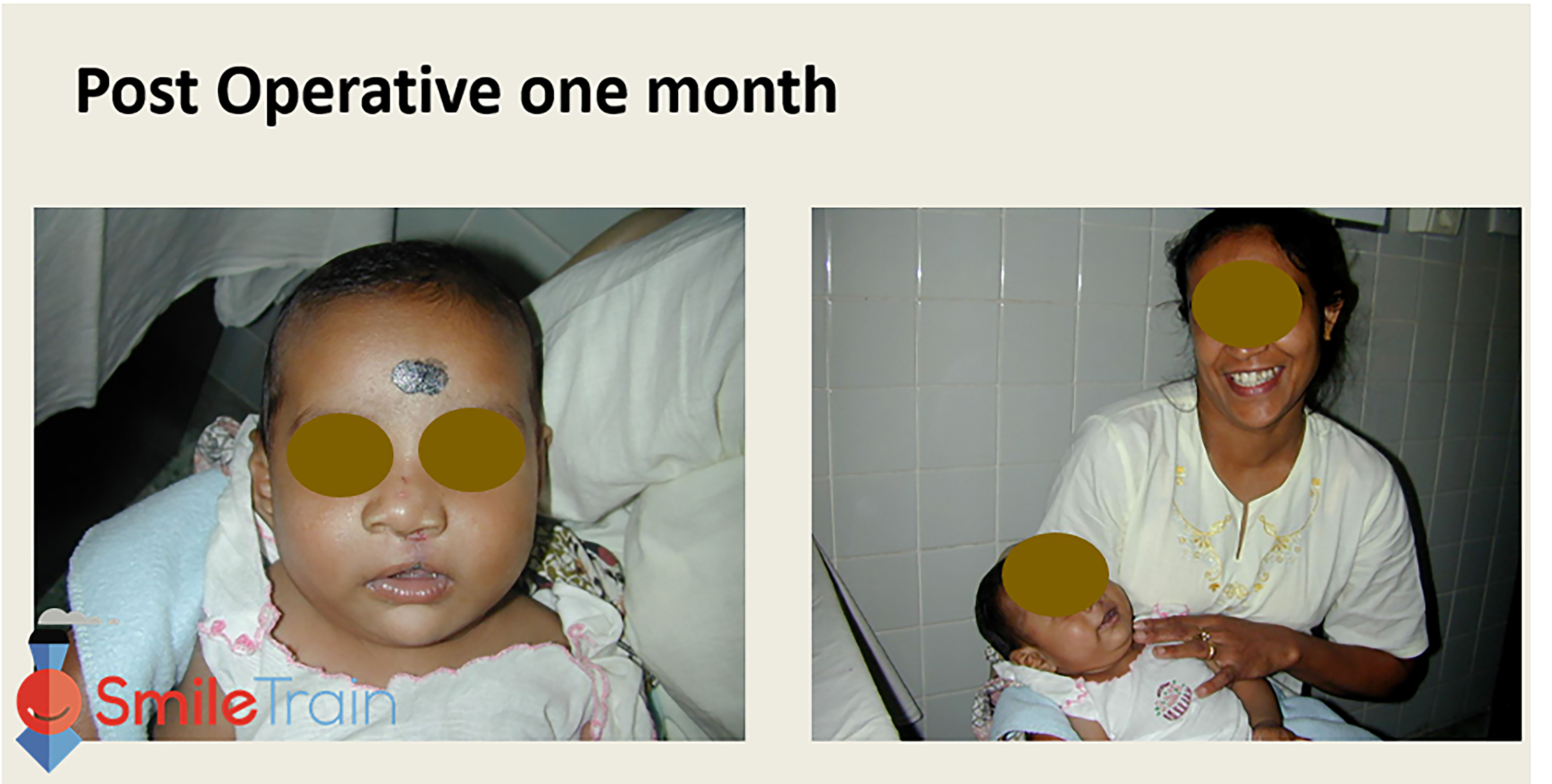 Cleft Lip - Unilateral Cleft Lip